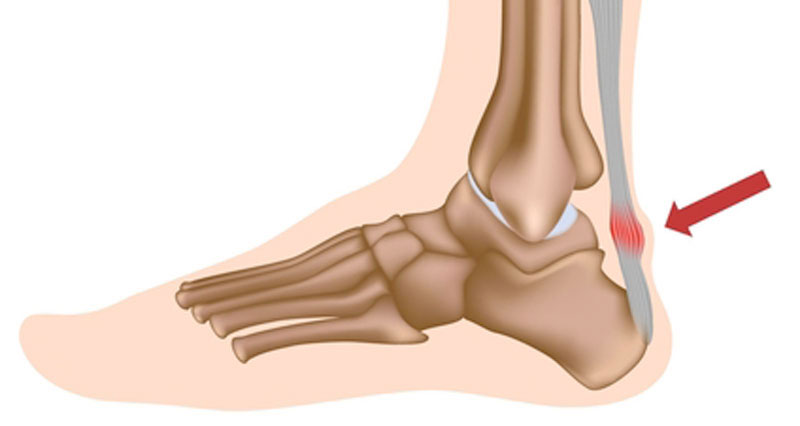 achilles tendonitis