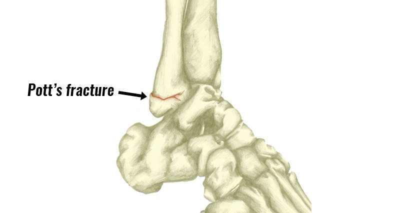 ankle-fracture560 ankle fracture