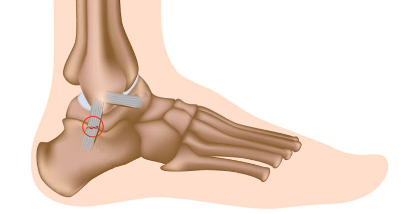 ankle-sprain560 sprained ankle