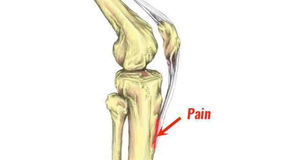 osgood560 Osgood Schlatter disease