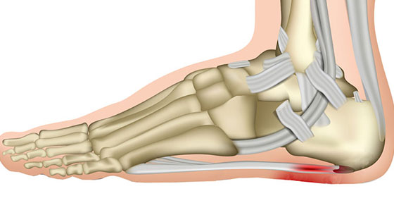 plantar-fasciitis500 plantar fasciitis