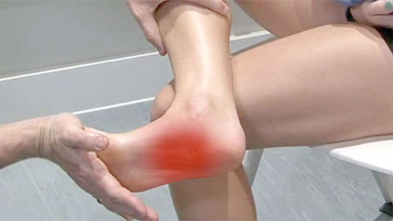plantar500 plantar fasciitis