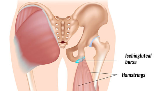 proximal hamstring tendonitis